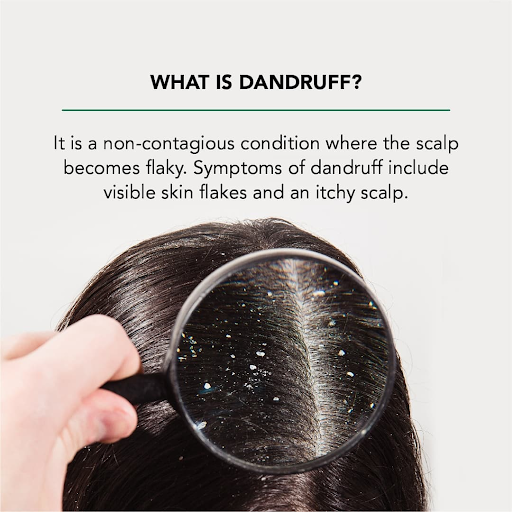 Natural Dandruff Solutions: Essential Oils and Herbs for Healthy Hair Natural Dandruff Solutions: Essential Oils and Herbs for Healthy Hair